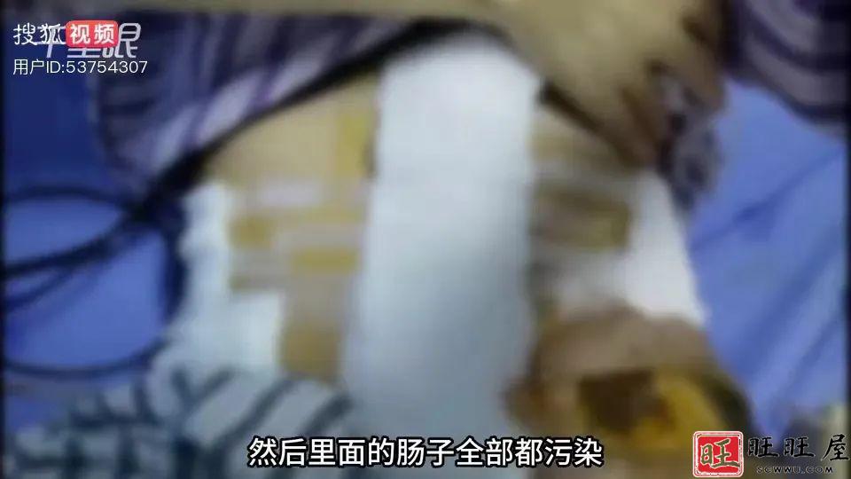 29岁女子两年间被丈夫家暴16次！肠子都被打断，需要终身挂粪袋